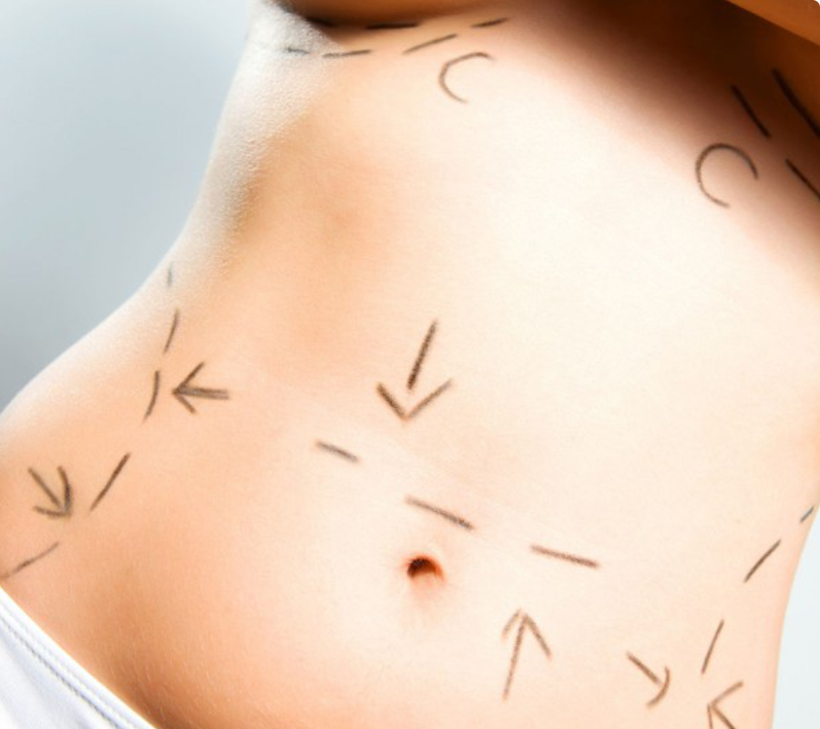 thumb-abdominoplastia